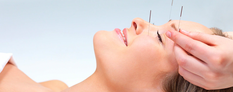 Acupuncture