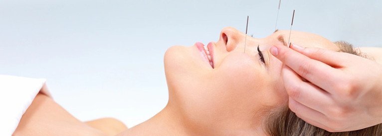 Acupuncture